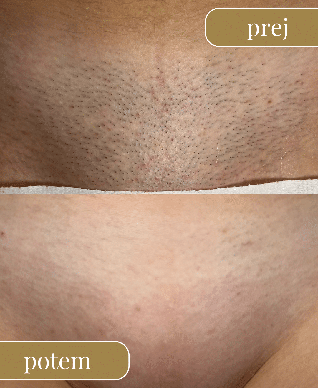 LaserHouseLjubljana-rezultati-nasih-strank-bikini.png
